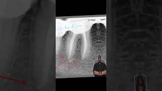 follow up1 year a case of acute periapical abcess الكربولة اكسبلور endodontics [upl. by Ettenoitna795]