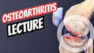 Osteoarthritis OA Presentation  Ortho High Yield Topics 04 [upl. by Nabal]