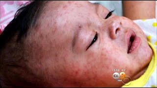 Health Alert Issued After More Measles Cases Noted [upl. by Kuth316]