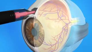 Glaucoma Cyclophotocoagulation CPC [upl. by Logan]