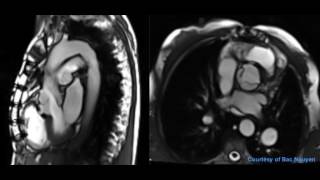 Aortic valve stenosis and regurgitation  Siemens 15T AERA [upl. by Valora]