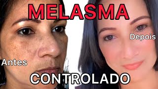 MELASMA CONTROLADO  VEJA O ANTES E DDPOIS  Silvania Sends [upl. by Graff]