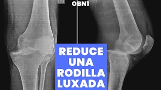 RODILLA LUXADA O DISLOCADA  APRENDE A REDUCIRLA [upl. by Sparke]