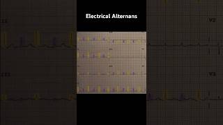 Electrical Alternans ECG Example 2 [upl. by Tiersten]