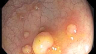 Colonoscopy Channel  Pseudomembranous colitis [upl. by Aimee]