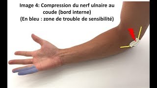 Nerf cubitale ulnaire soulagez sa compression naturellement [upl. by Alta75]