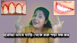 মাড়ি থেকে রক্ত বন্ধ করার ঘরোয়া টিপস।।😃😃🦷 Gum bleeding causes and its treatment at home ।। 😃😃 [upl. by Ecniv118]