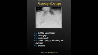 Radiographic signs of pulmonary edema  mnemonic [upl. by Aamsa]