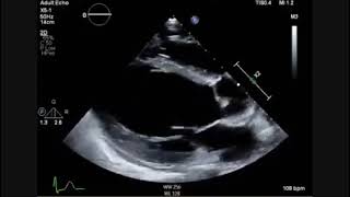 Acquired Gerbode Defect in a Patient With Infective Endocarditis of Bicuspid Aortic Valve [upl. by Gnah]