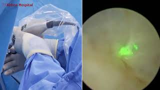 HOLEPHolmium laser enucleation of prostate [upl. by Spielman972]