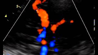 INTRACRANIAL ARTERIES TRANSCRANIAL COLOR DOPPLER [upl. by Oelc]