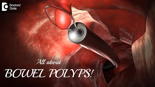 BOWEL POLYPS  How long does it take for a POLYP TO TURN INTO CANCERDrRavindra BSDoctors Circle [upl. by Jerroll119]