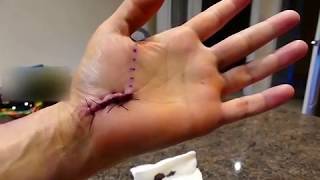 Removing gauze 6 days post Open Carpal Tunnel Surgery [upl. by Assennev456]