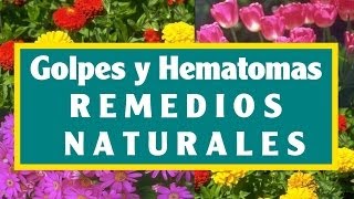 Consejos para Quitar los Moretones y Hematomas [upl. by Sharyl]