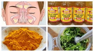 Best Natural Home Remedies for Sinusitis [upl. by Kalli]