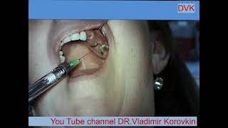 Infiltration Anesthesia for extration 232627 teeth [upl. by Norvin464]