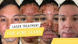 STRONGEST LASER TREATMENT FOR ACNE SCARS IS ROHRER AESTHETICS FULLY ABLATIVE CO2  Dr Jason Emer [upl. by Woodhouse244]