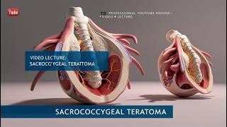 Fetal Neurosonography Sacrococcygeal Teratoma [upl. by Pack]