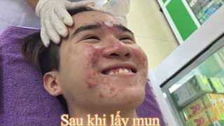 ROLLING NEEDLE REMOVE ACNE SCARS FOR VIET ANH  Hang Oliver [upl. by Whit]