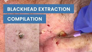 Extraction Satisfaction Blackhead Removal  CONTOUR DERMATOLOGY [upl. by Heinrick839]