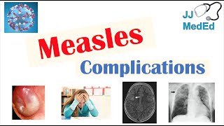 Measles Complications Immunosuppression Encephalitis SSPE etc Diagnosis Treatment Prevention [upl. by Haggerty]