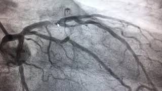 ANGIOPLASTIA Y STENT EN ARTERIA DESCENDENTE ANTERIOR EXITOSA [upl. by Nirihs]