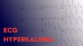 Hyperkalemia EKG Findings  ECG Interpretation [upl. by Derk954]