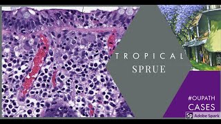 Tropical Sprue [upl. by Holle]