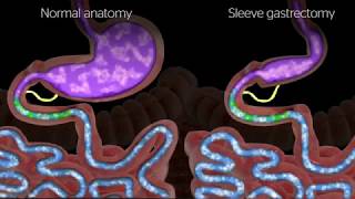 Sleeve Gastrectomy Procedure Animation [upl. by Adroj]