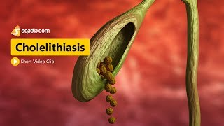 Cholelithiasis  I  Gastroenterology Medicine Animation  VLearning  sqadiacom [upl. by Llechtim]