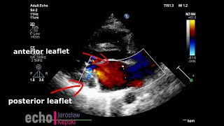 Myxomatous mitral valve degeneration MMVD posterior leaflet mitral regurgitation echocardiography [upl. by Lancelle]