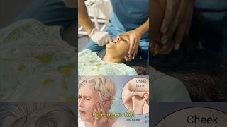 TMJ treatment by Chiropractor dr Pankaj ChoudharychiropractorinhyderabadHyderabadtrending [upl. by Aihsekel]