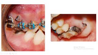 ¿Cómo es la intrusión molar en Ortodoncia y mini tornillos CUANDO UNA MUELITA SE SALE DEL HUESO 👍 [upl. by Khoury]