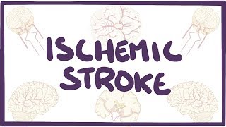 Ischemic Stroke  causes symptoms diagnosis treatment pathology [upl. by Breena]