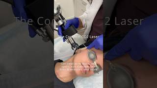 Get rid of ice pick acne scars with the CoolPeel CO2 Laser at Wise Med Spa acnescars [upl. by Abeu674]