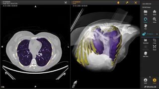 3D Slicer  Brainlab interoperability demonstration at RSNA 2015 [upl. by Suilenroc]