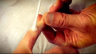 FREEZING 6 PAINFUL WARTS With Liquid Nitrogen  Dr Paul [upl. by Vergos]