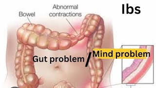 IBS gut problem Vs mind problemcolitis indigestionacidgasacidityconstipation [upl. by Ponton]