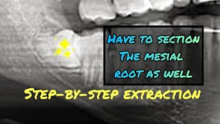 When the Mesial Root is Stuck Step by Step Wisdom Tooth Extraction Video with Instruments Listed [upl. by Henrie]