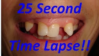 25 second dental makeover time lapse [upl. by Bianchi]