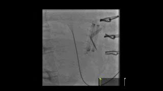 Fluoroscopy of a Mechanical Mitral Valve [upl. by Dorion]