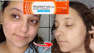 funciona mesmo minha experiência usando o gel azelan ácido azeláico [upl. by Yatzeck]