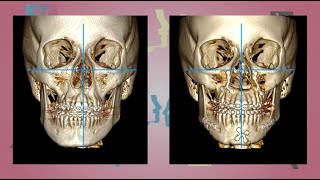 Case 14  Orthognathic surgery  Facial Asymmetry  English [upl. by Joey]