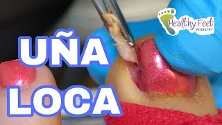 PRETTY PEDICURE RUINED BY A CRAZY INGROWN TOENAIL Uña Encargada Loca [upl. by Sheridan990]