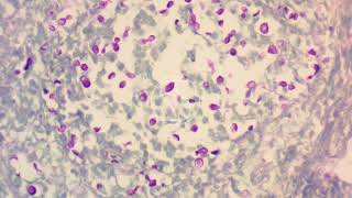 Cryptococcus neoformans under the microscope with McManus’ PAS stain [upl. by Endaira]