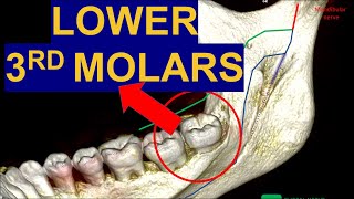 Secrets of Impacted Lower Third Molars CBCT Surgical extraction of wisdom teeth removal surgery [upl. by Austen282]