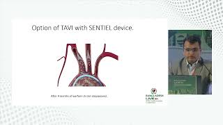 TAVR My Experience Nepal Perspective by Dr Chandra Mani Adhikari [upl. by Anohsal]