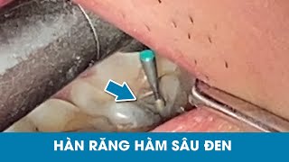 Cách chữa răng hàm bị sâu  Hàn răng hàm bị sâu  Nha Khoa Oze [upl. by Dennard]