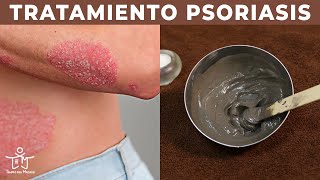 PSORIASIS en la PIEL ⚡  El MEJOR TRATAMIENTO en 3 PASOS 💧 [upl. by Emalee417]