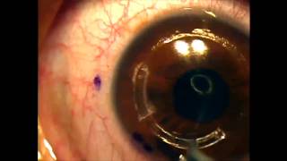 Intacs for keratoconus using the intralase femtosecond laser [upl. by Daryle212]